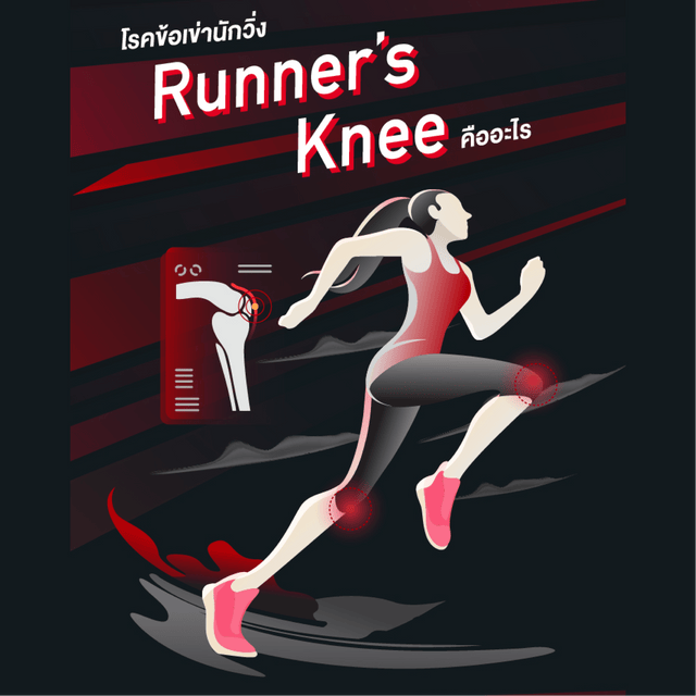 โรคข้อเข่านักวิ่ง Runner’s Knee คืออะไร - MCDAVID